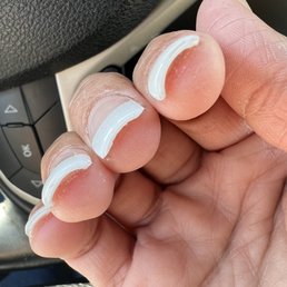 Uneven nails and gunk under nail Uneven nails and gunk under nail