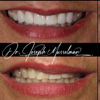 Musselman Dentistry - A beautiful smile make over! Our lovely patient was unhappy with her smile and she was ready for a change! Dr. Musselman delivered. - General Dentistry Near Me - Phoenix, Arizona