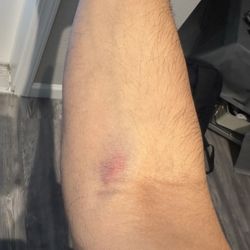Quest Diagnostics - After blood draw, I wont recommend this lab