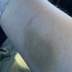 South Strand Medical Center - More bruises from mostly blind needle sticks.