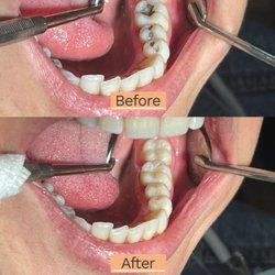 Magnolia Modern Dental - Amalgam to Composite Bonding Restorations