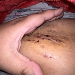 Atif Iqbal MD - New Life Surgery - Huge incision made on my stomach, no one explained me why and I have never seemed it on a bariatric patient before.