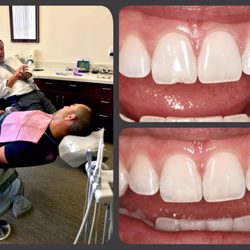 Curtis L. Chan, DDS, A Professional Dental - Cleaning, Exam and Repair chipped tooth