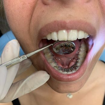 Embrace Smile Studio - Lingual braces hidden behind the teeth - Orthodontists Near Me - Toluca Lake, California Embrace Smile Studio - Lingual braces hidden behind the teeth - Orthodontists Near Me - Toluca Lake, California