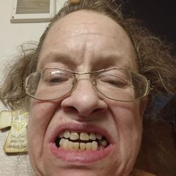 Free Implants NOW - Top teeth are rotting