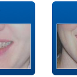 Rego Park Dental Care: Hyeong Kim - Veneers