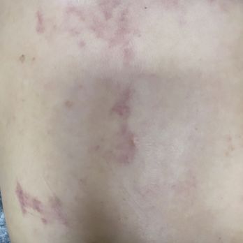 Sunny Foot Massage - My back after a full body massage - Massage Near Me - Los Angeles, California