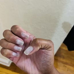 Infected nails Infected nails