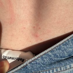 Relais Christine - Bed bug bites - "breakfast,lunch, and dinner"