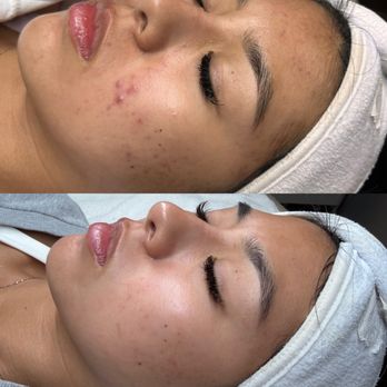 Amla Esthetics - Acne Bootcamp graduate - Skin Care Near Me - Long Beach, California Amla Esthetics - Acne Bootcamp graduate - Skin Care Near Me - Long Beach, California