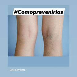 Peripheral Vascular Associates - Varices