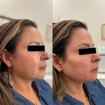 Luxe Culture - Cheek + Jawline filler with Radiesse - Permanent Makeup Near Me - Willow Park, Texas Luxe Culture - Cheek + Jawline filler with Radiesse - Permanent Makeup Near Me - Willow Park, Texas