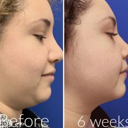 Neck lift
