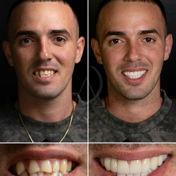 Aria Smile Design - veneers - Cosmetic Dentists Near Me - Miami, Florida Aria Smile Design - veneers - Cosmetic Dentists Near Me - Miami, Florida