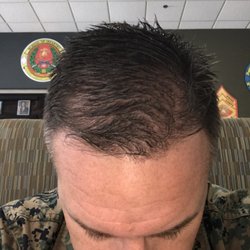 Bosley Hair Restoration & Transplant - Jul 2017