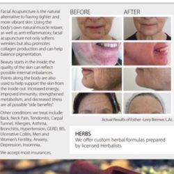 Original Breath Acupuncture - Facial Rejuvenation and Micro needling