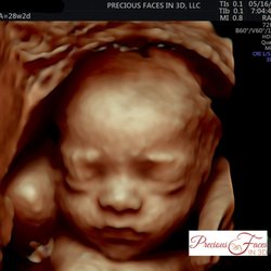 Precious Faces In 3D - Baby in 3D at 28w2d gestation