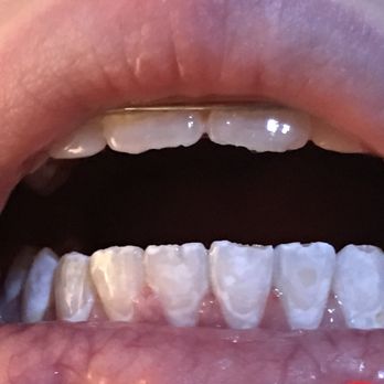 Pappas & Tapley Orthodontics - All her teeth are chipping on top. - Orthodontists Near Me - Gainesville, Florida Pappas & Tapley Orthodontics - All her teeth are chipping on top. - Orthodontists Near Me - Gainesville, Florida