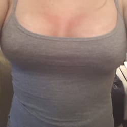 Amnon E Sadeh, MD - This is a week post op...Again feeling amazing  and very.happy with results!!!