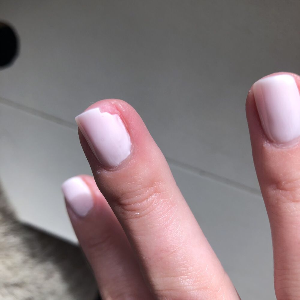 Broken nail just after two days and so painful. Broken nail just after two days and so painful.