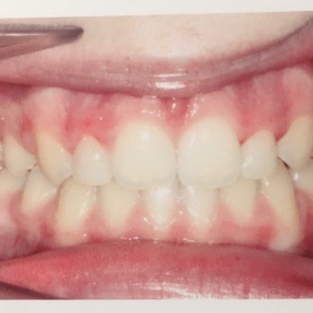 Updike Orthodontics - After treatment - Orthodontists Near Me - Irvine, California