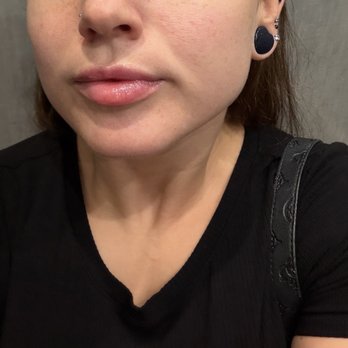 NakedMD - After , came back for a gummy smile tox as well. - Medical Spas Near Me - Glendale, California