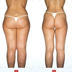 Love Your Body Endermologie & Endospheres - #endermologiebeforeandafter #endermologielosangeles #endermologiemanhattanbeach #bestcellulitetreatment #saygoodbyetocellulite #lpgsouthbay