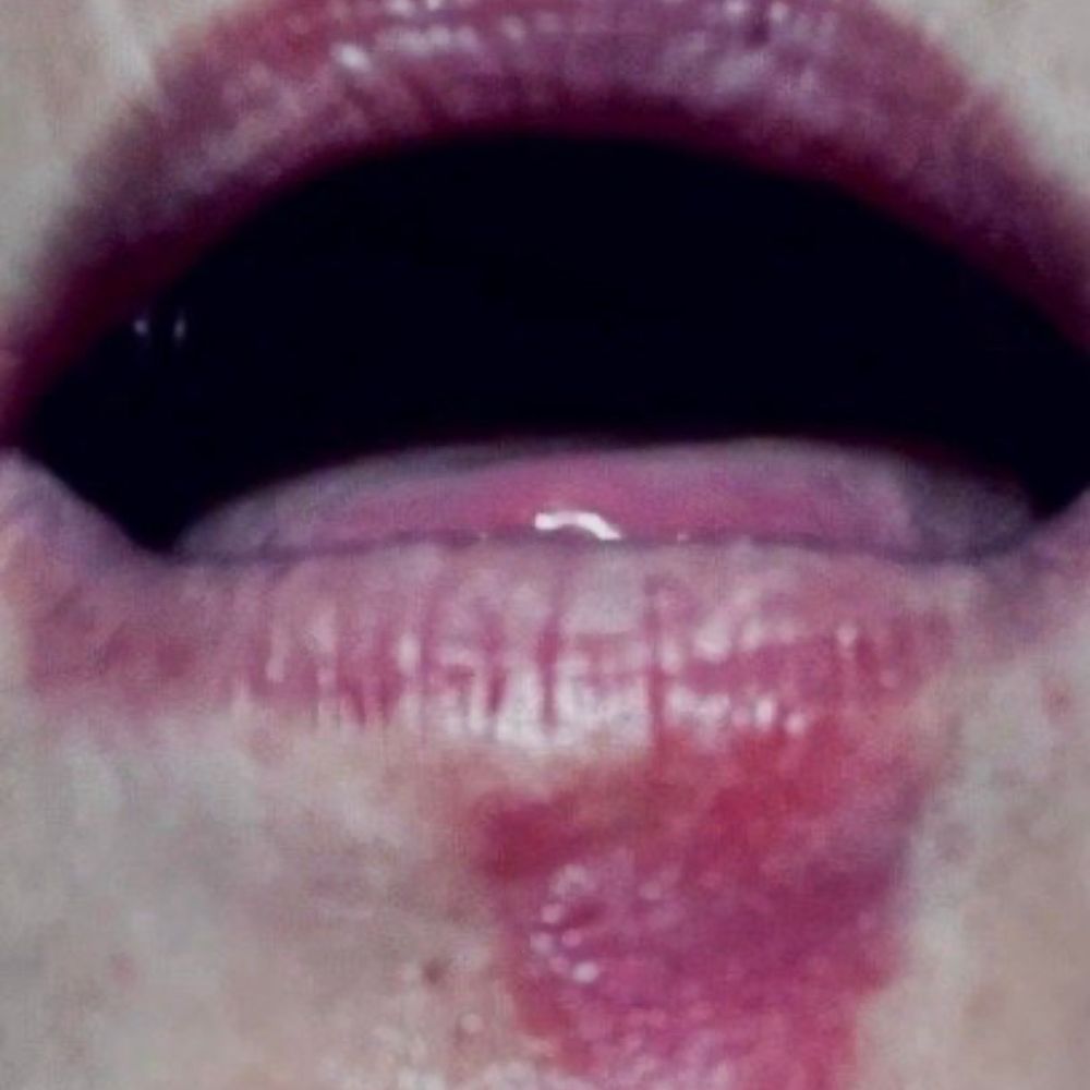 Community Care Rheumatology - My bad cold sore - Rheumatologists Near Me - Malta, New York Community Care Rheumatology - My bad cold sore - Rheumatologists Near Me - Malta, New York