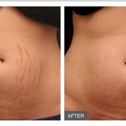 Dallas Medical Aesthetics - Stretch Mark Reduction