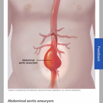 Grossman Gary, MD - Abdominal Aortic aneurysm - Doctors Near Me - Las Vegas, Nevada Grossman Gary, MD - Abdominal Aortic aneurysm - Doctors Near Me - Las Vegas, Nevada