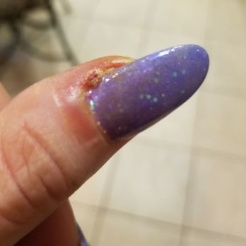 Red Persimmon Nails - Day 5, un set treatment from doctor. Bernadine and antibiotics. - Nail Salons Near Me - Las Vegas, Nevada