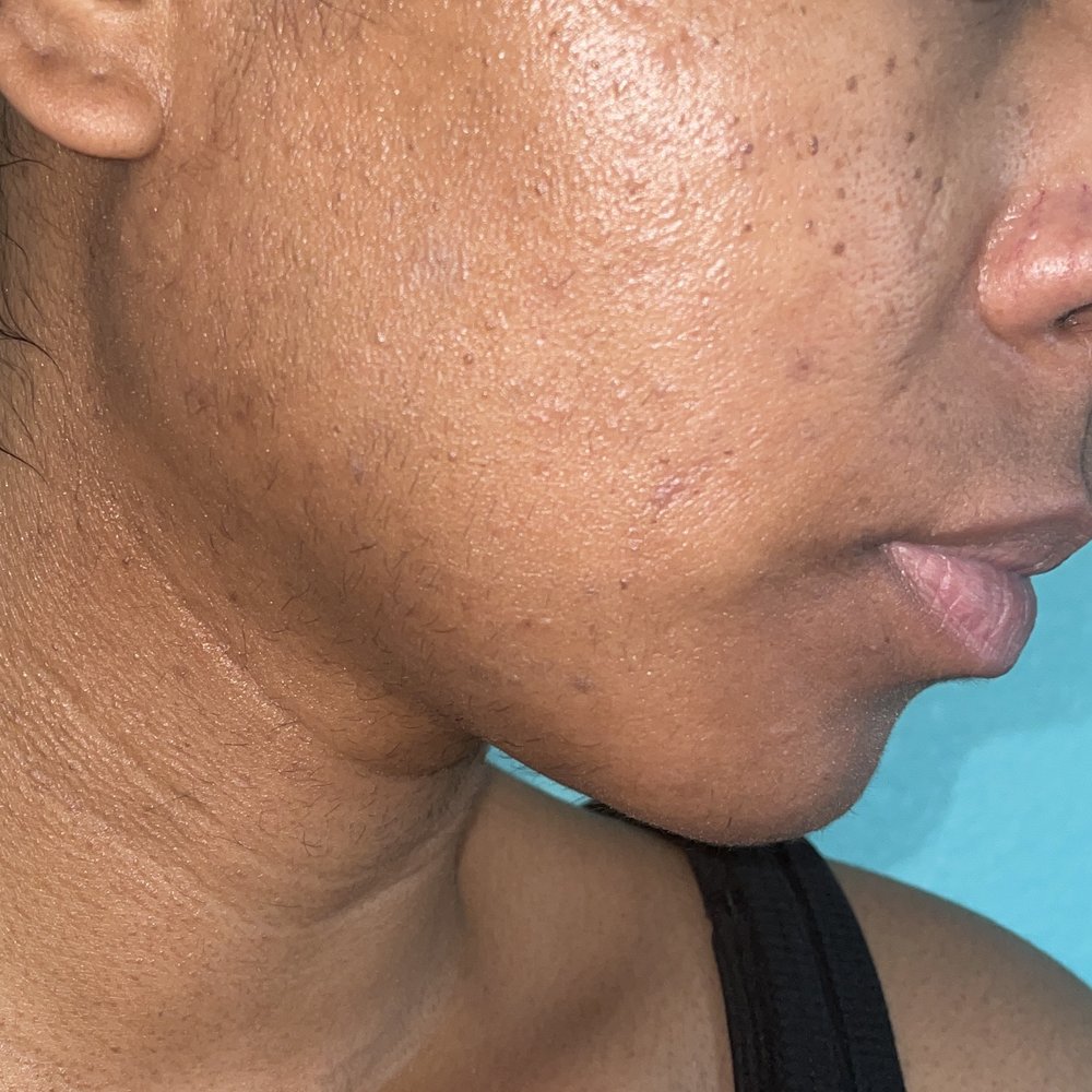 LaserAway - Medical Spas Near Me - Rancho Cucamonga, California LaserAway - Medical Spas Near Me - Rancho Cucamonga, California