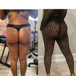 30 ML of hyaluron butt filler