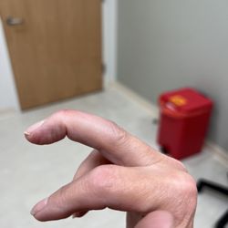 Coastal Orthopedic Associates - Mallet finger.