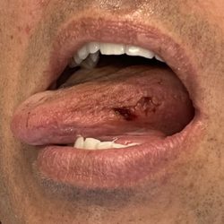 Naples Center for Cosmetic Dentistry - tongue damage from dentist