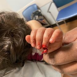 Mercy Health - Partially amputated finger on a 1 yr old