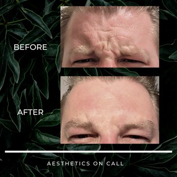 Aesthetics On Call - Subtle reduction in wrinkles for a male client who didn't want to look "done". - Medical Spas Near Me - Honolulu, Hawaii
