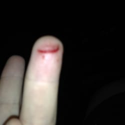 MedSpring Urgent Care - Same condition of my finger after my visit to MedSpring, no better, cut fully opened as before and bleeding.