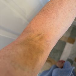 RAYUS Radiology - Black and blue and swelling a few days after incorrectly injecting needle
