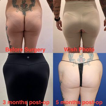 Ryan A. Stanton, MD - Before, Wish, 3 month post op and 5 month post op. - Cosmetic Surgeons Near Me - Los Angeles, California