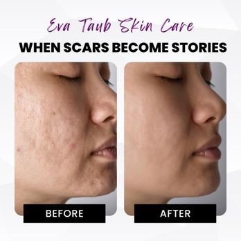 Eva Taub Skin Renewal Method - Depicting the before and after of my special scar reducing clinical treatments. - Skin Care Near Me - Newnan, Georgia Eva Taub Skin Renewal Method - Depicting the before and after of my special scar reducing clinical treatments. - Skin Care Near Me - Newnan, Georgia