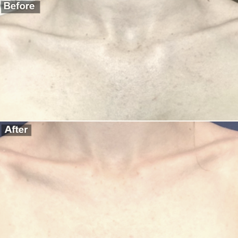 Medical Dermatology Associates of Chicago - Before and after chemical peel treatments done by Sara C. Goodbye sunspots/chest pimples, hello healthy/glowing skin! - Dermatologists Near Me - Chicago, Illinois Medical Dermatology Associates of Chicago - Before and after chemical peel treatments done by Sara C. Goodbye sunspots/chest pimples, hello healthy/glowing skin! - Dermatologists Near Me - Chicago, Illinois
