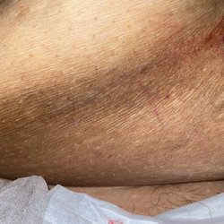Retirement & Nursing Center - Rash from diaper irritation
