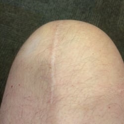 Shannon Cooke, MD - One year ago, knee was replaced!