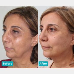 David B Samimi, MD - A deep plane facelift on this patient to rejuvenate her face