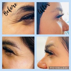 Graceful Lines Aesthetics - Crows Feet