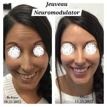Beauty and Butterflies Med Spa - Before & After NeuroModulator Jeuveau - Medical Spas Near Me - Apache Junction, Arizona Beauty and Butterflies Med Spa - Before & After NeuroModulator Jeuveau - Medical Spas Near Me - Apache Junction, Arizona
