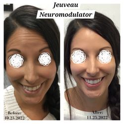 Beauty and Butterflies Med Spa - Before & After NeuroModulator Jeuveau