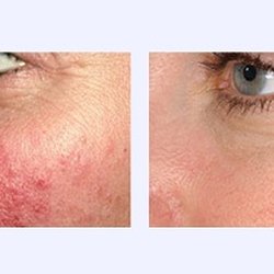 Executive Skin and Laser - IPL Photo-facial laser reduces redness on the skin.