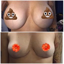 Before and a year and 3 months out explant, Lift and fat transfer. Before and a year and 3 months out explant, Lift and fat transfer.